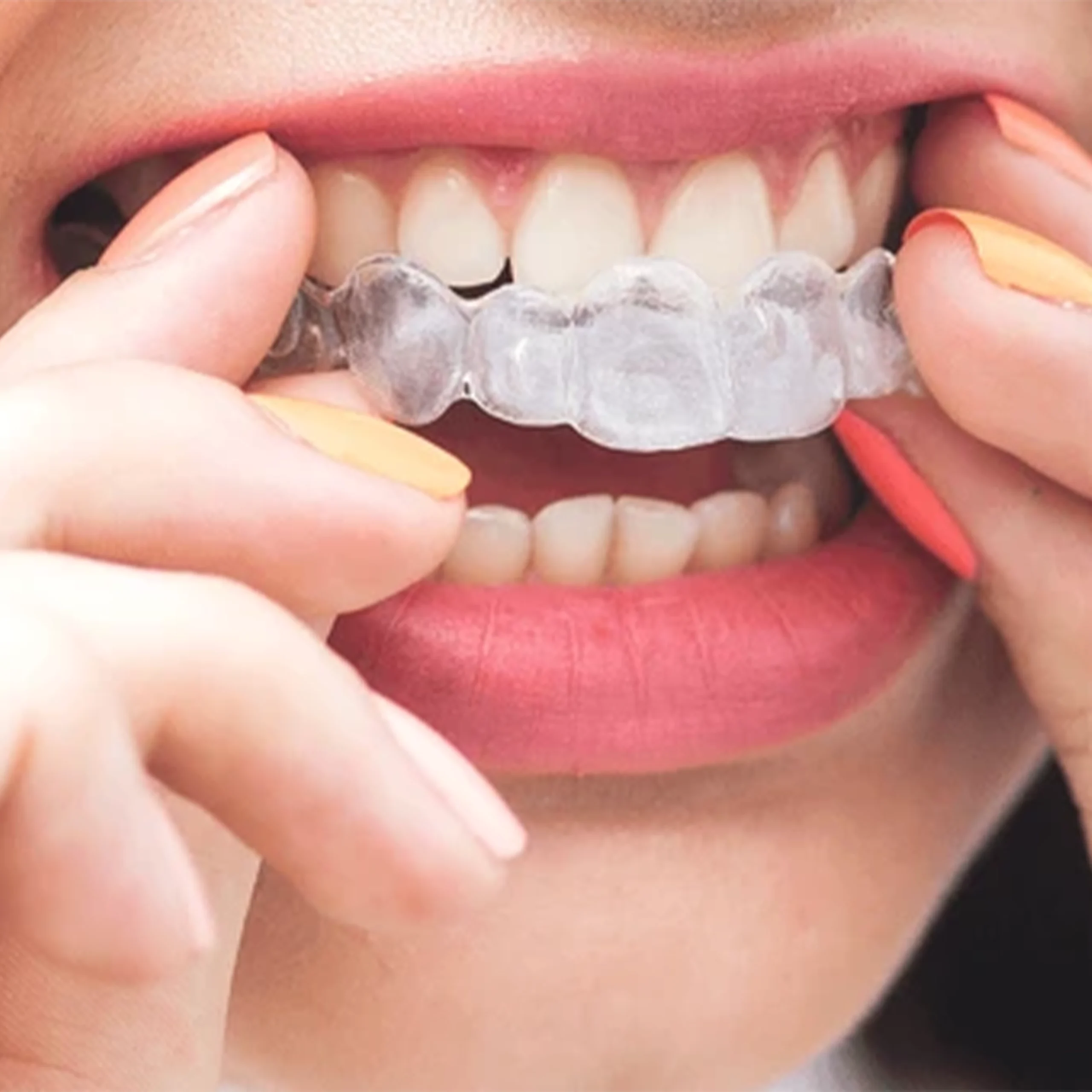 Invisible Aligners Price in Karachi