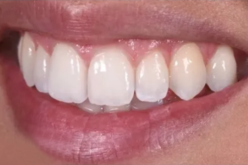 After Aligners