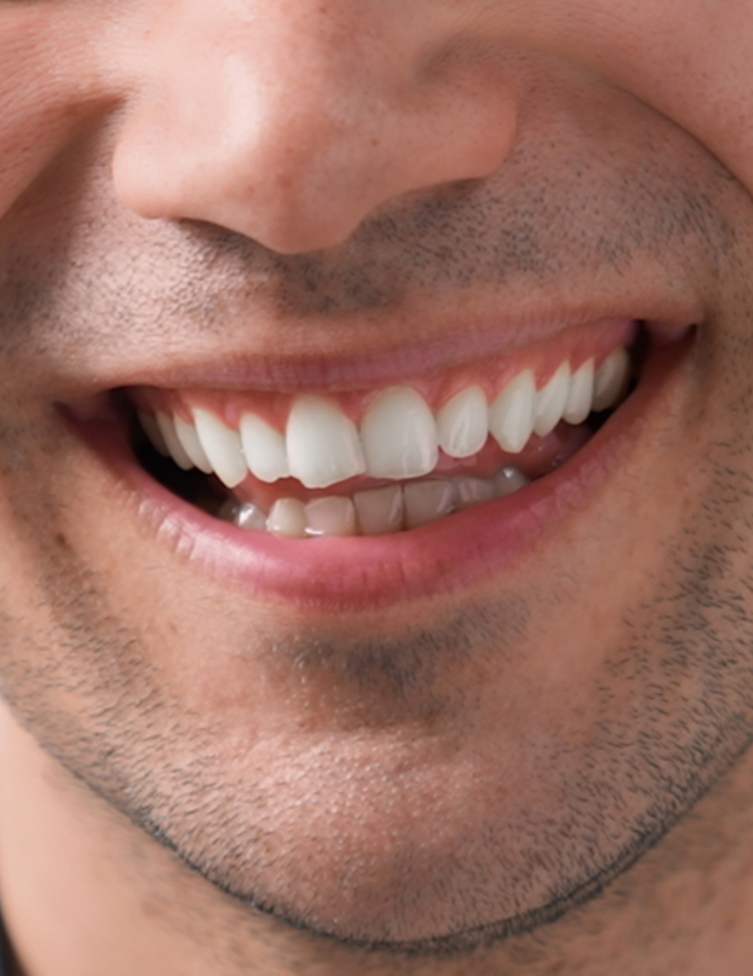 Gum recession treatment in karachi