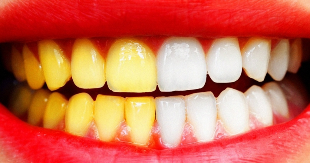 make yellow teeth white